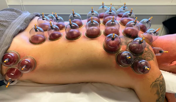 Cupping massage i Randres ved Massage Studio